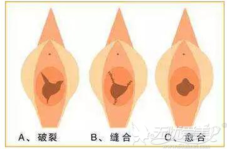 处女膜修复术后效果