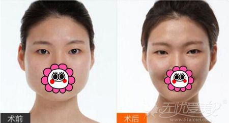 北京欧兰美下颌角手术案例