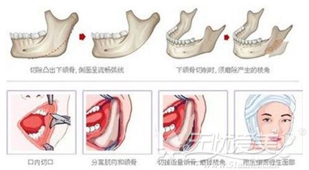 北京欧兰美下颌角的手术方法