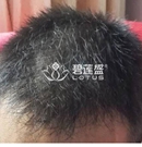分享在北京碧莲盛做完植发手术8个月后 拥有一头浓密的头发