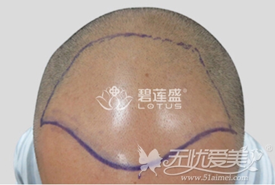 在北京碧莲盛做完植发手术前设计