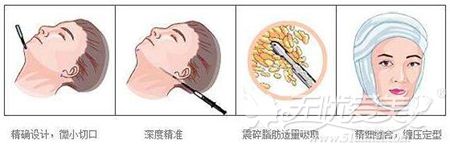北京汇美下颌吸脂整形手术过程