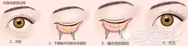 嘉兴禾美内路法祛眼袋手术过程