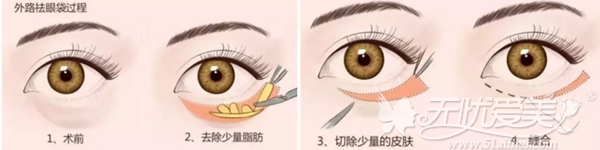 嘉兴禾美外路法祛眼袋手术过程