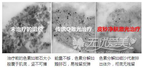 南京斑蜂巢皮秒激光祛斑优势