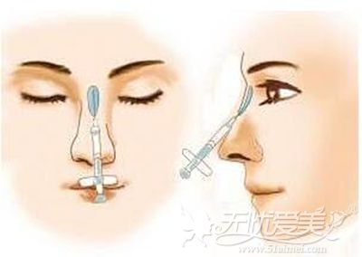 深圳美莱注射玻尿酸隆鼻的方法