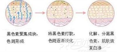 广州威利斯激光祛斑的过程