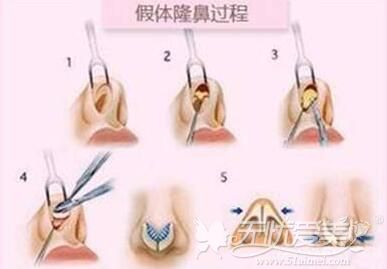 哈尔滨雅美做鼻综合的手术过程