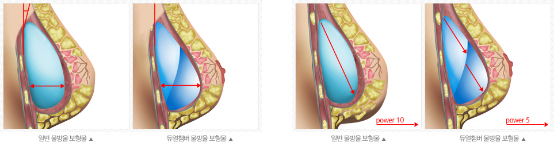 韩国朱诺假体隆胸手术