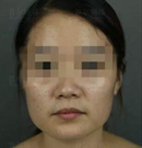找上海首尔丽格朴兴植做下颌角+质骨切除术后告别了四方脸
