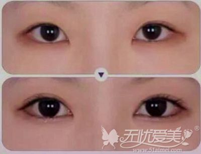 长春刘晓娟全切双眼皮+开眼角的方法