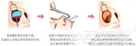 溧阳德尔美客假体隆鼻的手术方法
