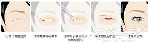 广州轻伊美的双眼皮手术过程