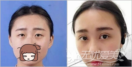 盘锦克拉拉韩式双眼皮手术案例