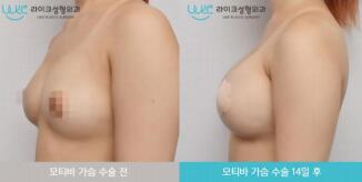 韩国like整形医院假体隆胸手术案例