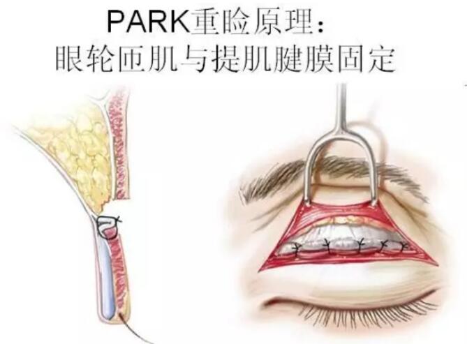 Park法重睑术双眼皮手术原理