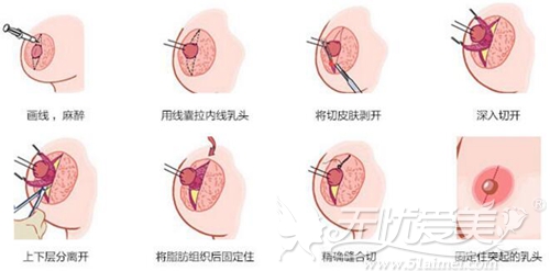 成都米兰柏羽乳头内陷矫正