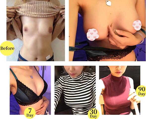 北京斯悦涵美自体脂肪隆胸手术案例