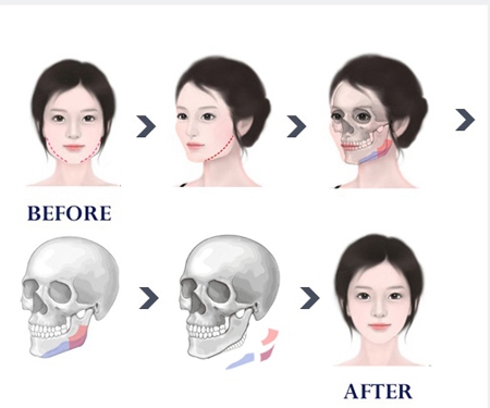 韩国Face-Line整形外科颌面整形