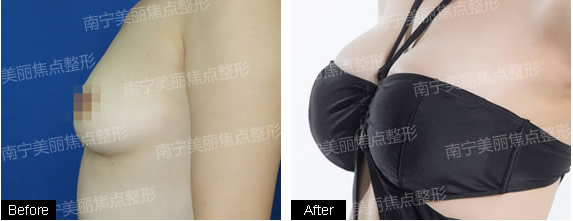 桂林美丽焦点内窥镜隆胸手术案例