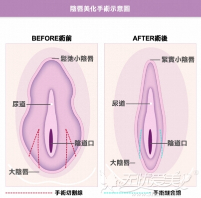 合肥阴唇整形手术