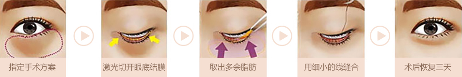 南京米尚恩整形祛眼袋手术