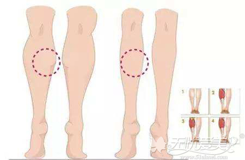 瘦腿可解决肌肉型小粗腿