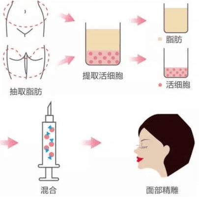 韩国劳波儿面部自体脂肪填充过程