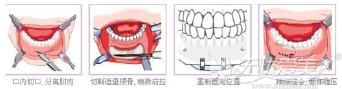 假体垫下巴的手术过程