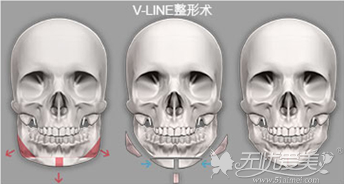 V-Line改脸型手术原理