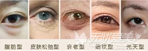 衢州芘丽芙三种祛眼袋手术让你告别眼睛衰老重放“睛”彩