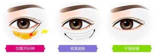 广州中科祛眼袋手术过程