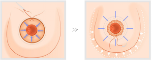 广州美涵巨乳缩小手术过程