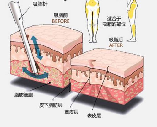 广州美涵吸脂手术