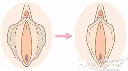 手术阴道紧缩后效果