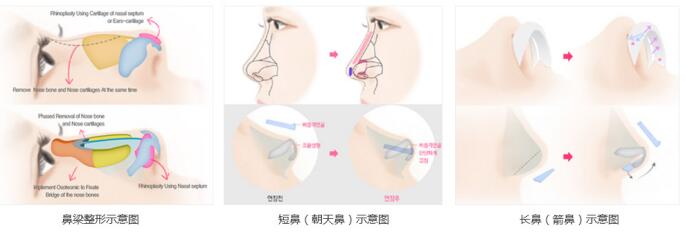 隆鼻手术过程