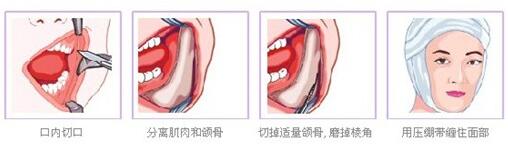 东莞星采下颌角整形手术过程