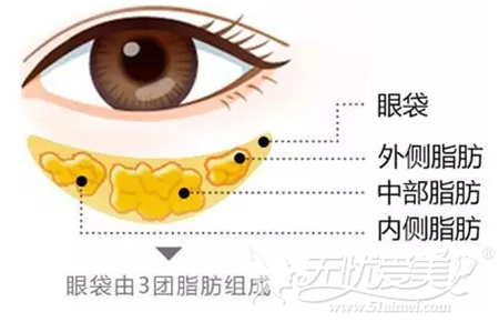 北京丽都解析眼袋的形成