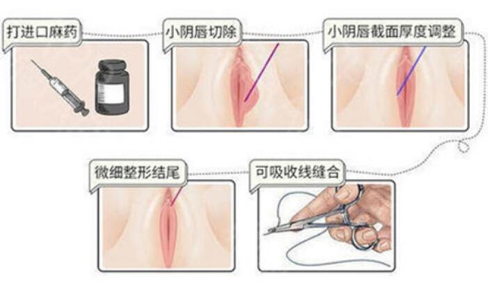 重庆伯思立小阴唇整形