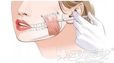 武汉伽美星注射瘦脸针的位置在咬肌