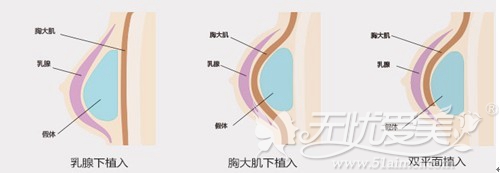 西宁时光假体隆胸手术方法