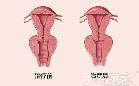 武汉三仁整形阴道紧缩术