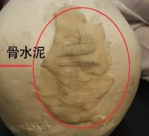 韩国雕刻后脑勺填充术