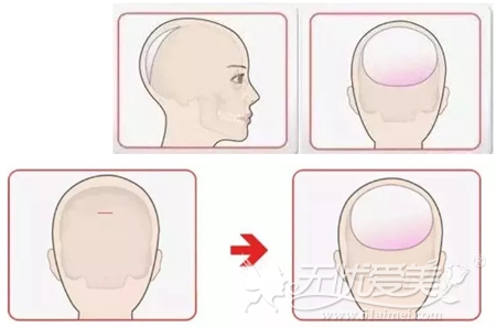 韩国雕刻后脑勺填充术过程
