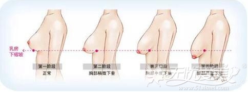 上海天大胸部下垂提升手术技术如何?B罩想变D罩能做吗?