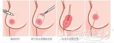 上海天大对于轻度乳房下垂的矫正