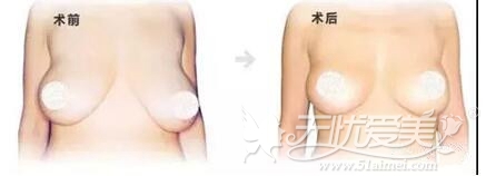 上海天大对于重度乳房下垂的矫正