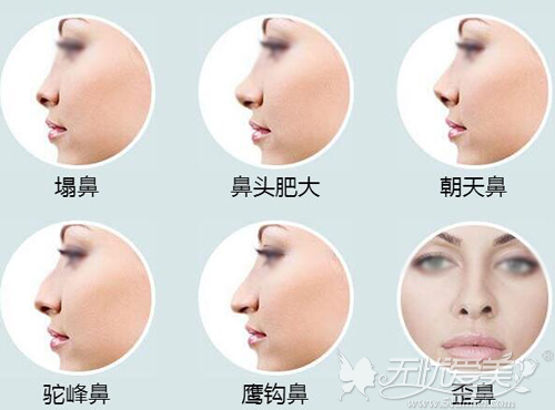 东方人常见的各种鼻型