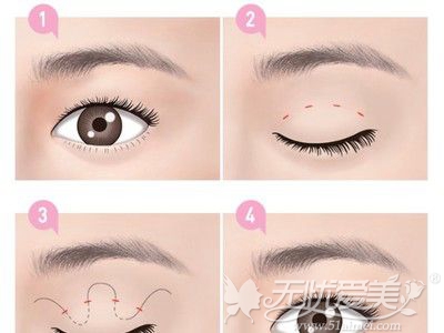 广州禾丽韩式微创双眼皮手术方法