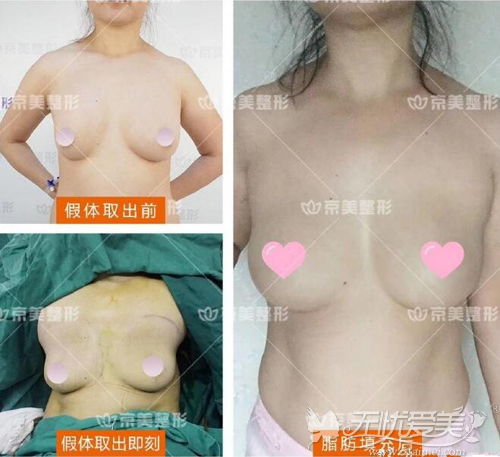 刘成胜隆胸假体取出自体脂肪丰胸案例